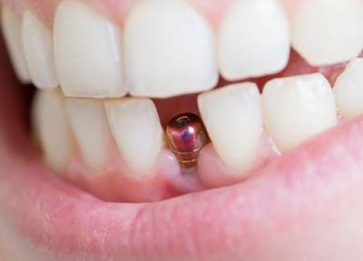 ایمپلنت دندان های قدامی و مسائل کشیدن زود رس دندان ها