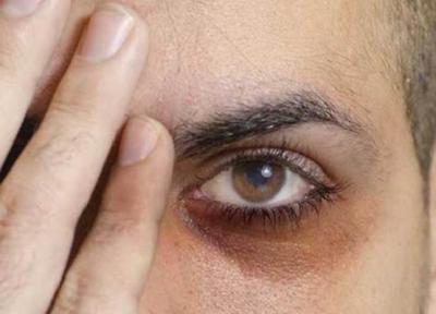 حلقه های تیره پای چشم به چه دلایلی ایجاد می گردد؟