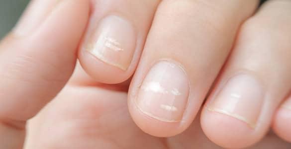 لکه های سفید روی ناخن (لوکونیشیا)؛ دلایل و روش های سریع و خانگی برای درمان آن